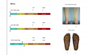 XSOL DUO Foot Plantar Scanner Report